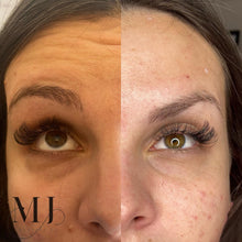 Load image into Gallery viewer, Anti Wrinkle Treatments