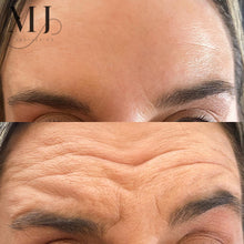 Load image into Gallery viewer, Anti Wrinkle Treatments