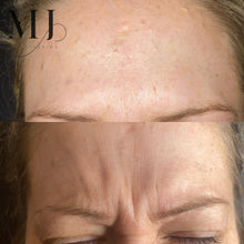 Load image into Gallery viewer, Anti Wrinkle Treatments