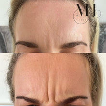 Load image into Gallery viewer, Anti Wrinkle Treatments
