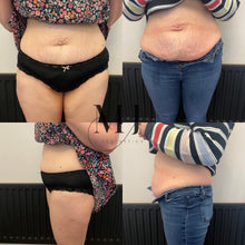 Load image into Gallery viewer, Fat Dissolving - Large Area (Stomach, Thighs, Arms)