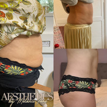 Load image into Gallery viewer, Fat Dissolving - Large Area (Stomach, Thighs, Arms)