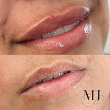 Load image into Gallery viewer, Lip Enhancement (Standard)