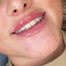 Load image into Gallery viewer, Lip Enhancement (Standard)