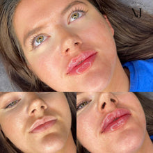 Load image into Gallery viewer, Lip Enhancement (Premium Brand)