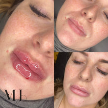 Load image into Gallery viewer, Lip Enhancement (Premium Brand)