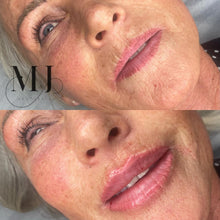 Load image into Gallery viewer, Lip Enhancement (Standard)