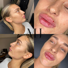 Load image into Gallery viewer, Lip Enhancement (Premium Brand)