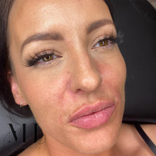 Load image into Gallery viewer, Lip Enhancement (Premium Brand)