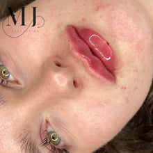 Load image into Gallery viewer, Lip Enhancement (Premium Brand)