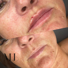 Load image into Gallery viewer, Lip Enhancement (Premium Brand)