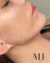 Load image into Gallery viewer, Dermal Filler Packages