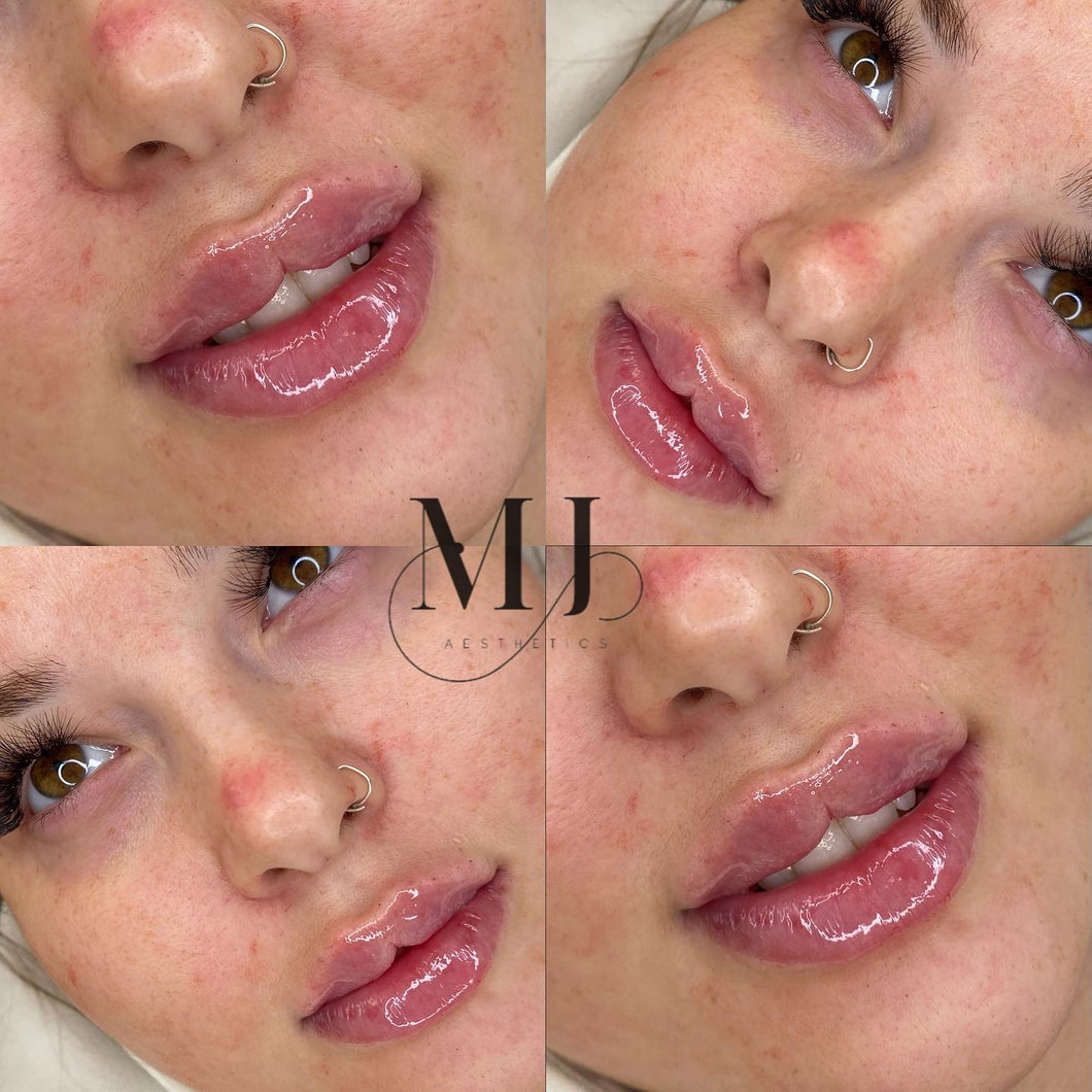 Lip Enhancement (Standard)